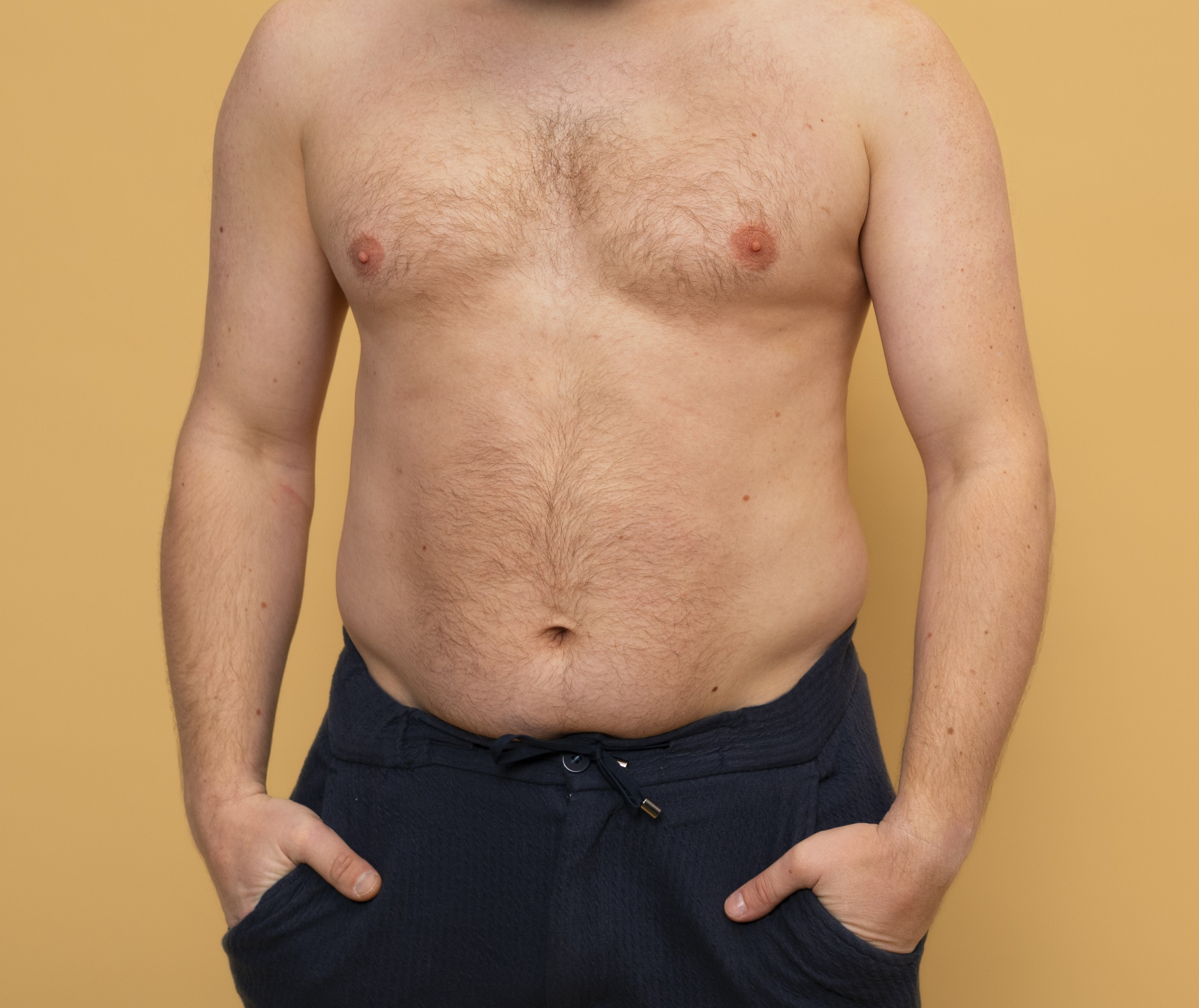 Gynecomastia