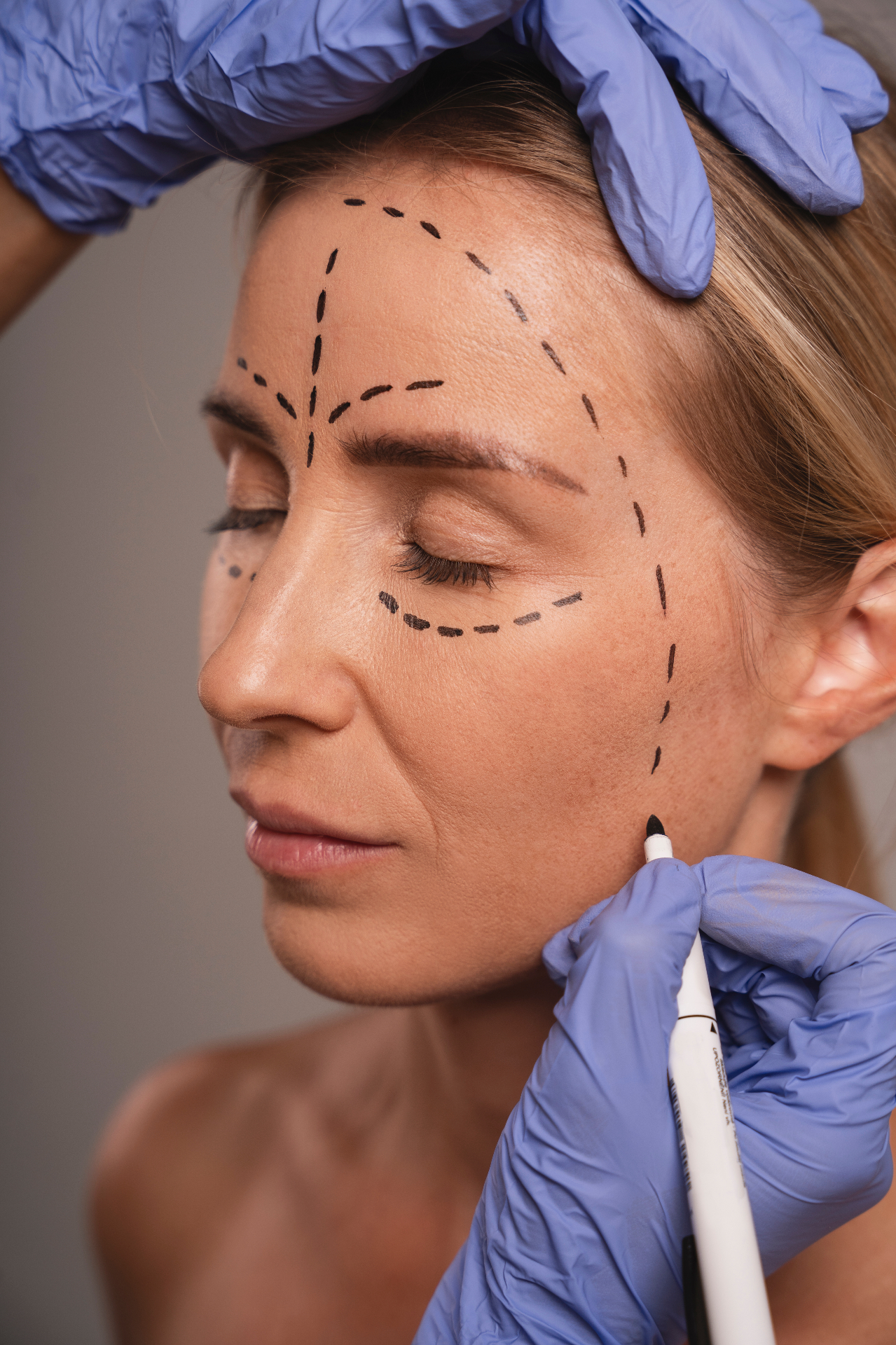 Endoscopic Forehead Brow Lift using Endochor