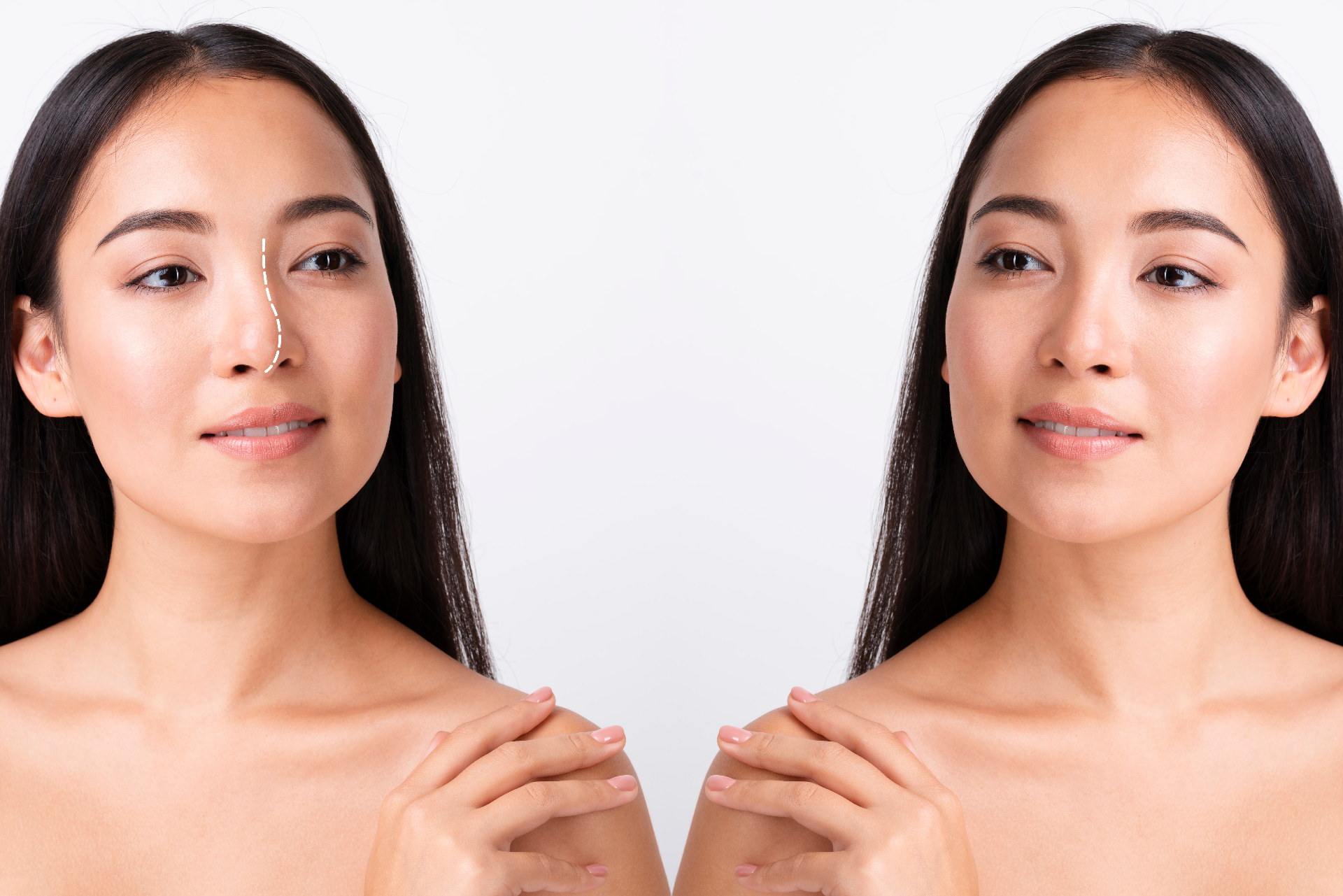 Rhinoplasty Hero