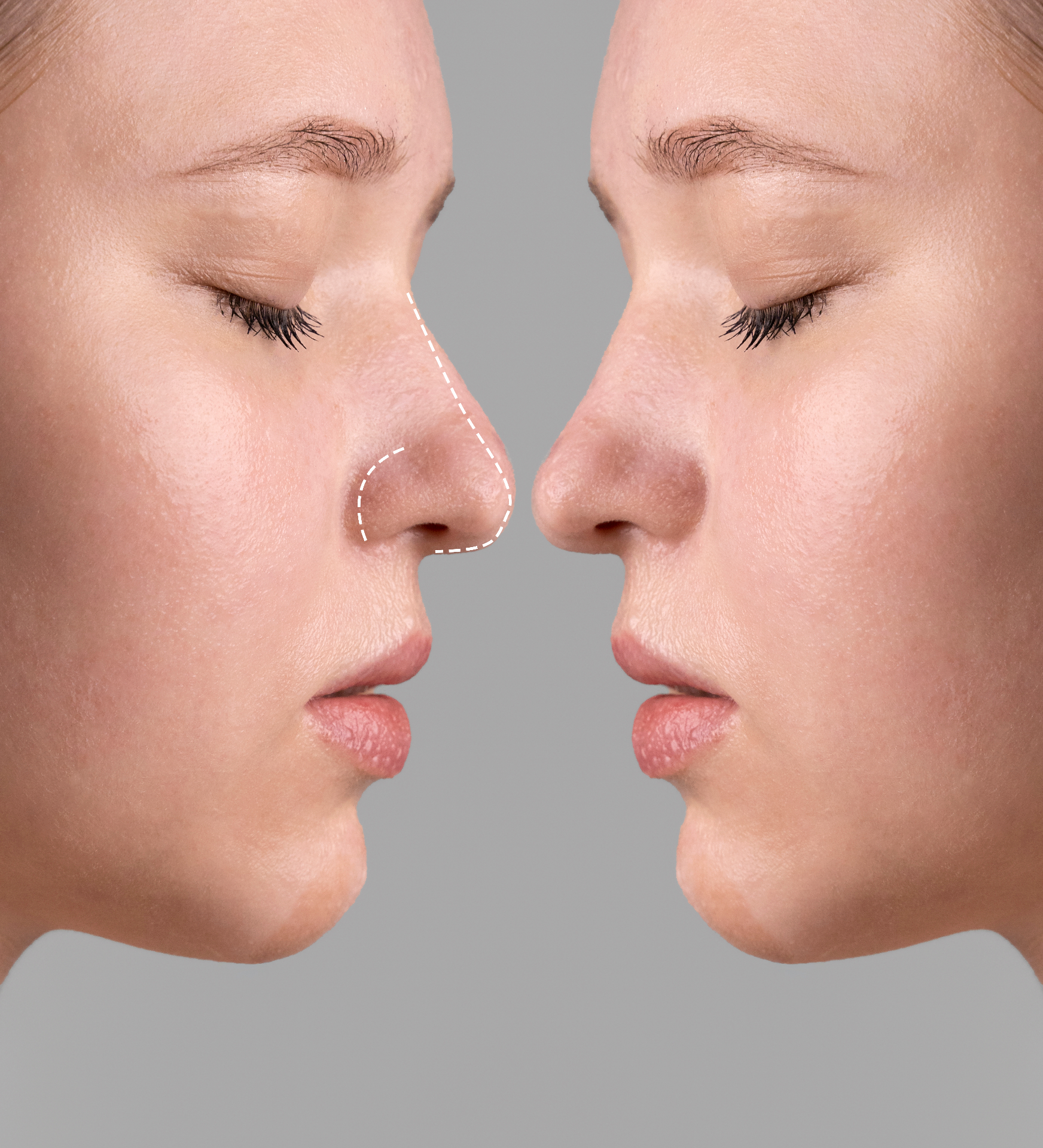 Rhinoplasty procedure