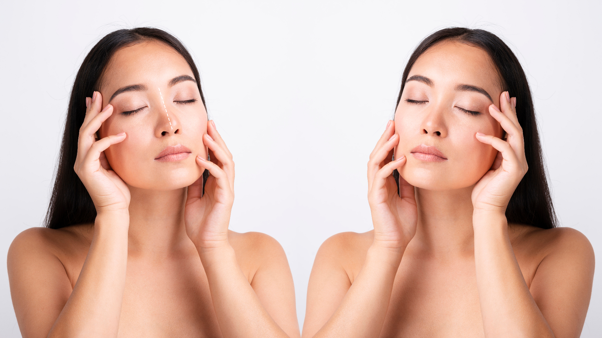 EndoChor Transblepharoplasty Implant Surgery